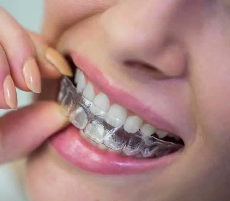 Custom-made clear aligners in Silver spring Montgomery County