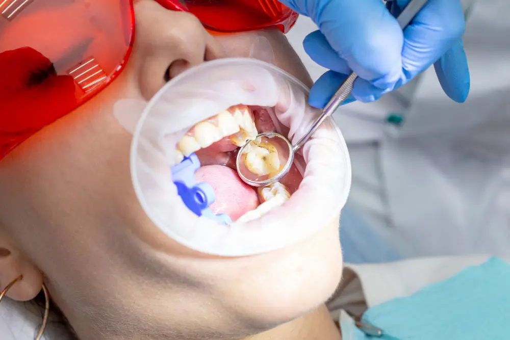 Patient receiving a dental filling at Kraja and Sidhu Dental Office in Silver Spring, Maryland