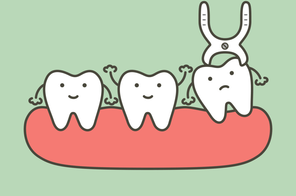 wisdom tooth removal process illustrated in an animation
