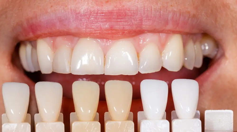 Composite veneers at Kraja and Sidhu Dental in Silver Spring