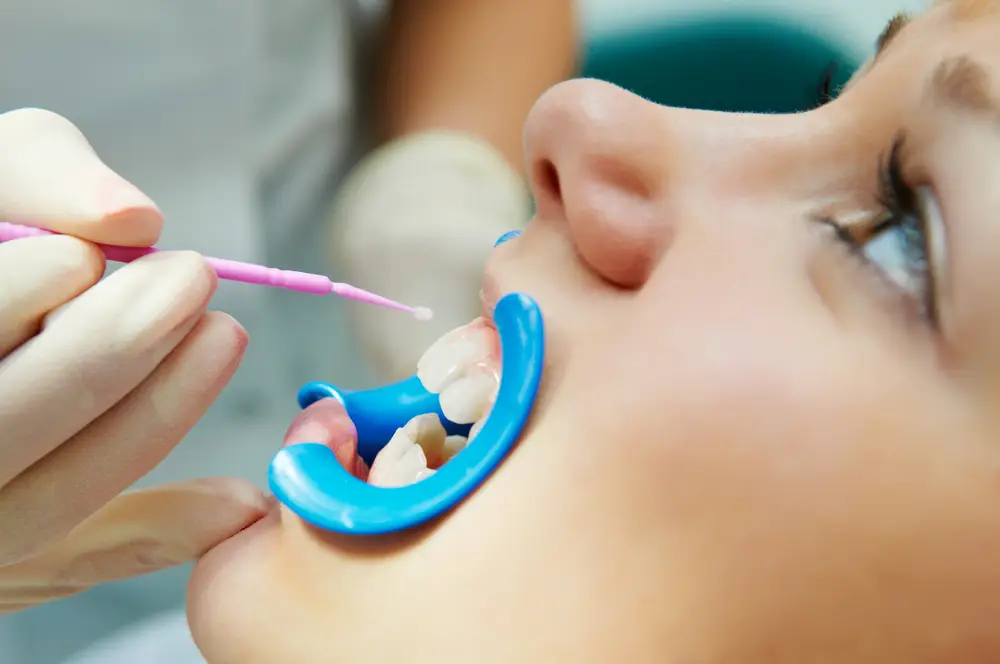 An adolescent getting dental sealants for kids at Kraja and Sidhu Dental clinic in Silver Spring