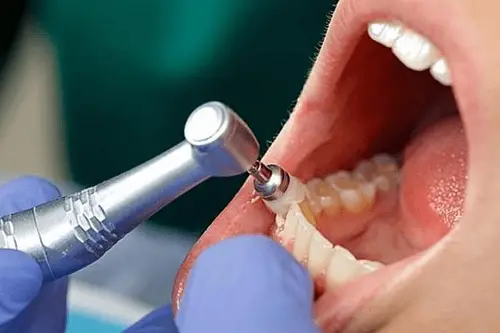 Patient receiving oral prophylaxis treatment at Kraja and Sidhu Dental in Silver Spring