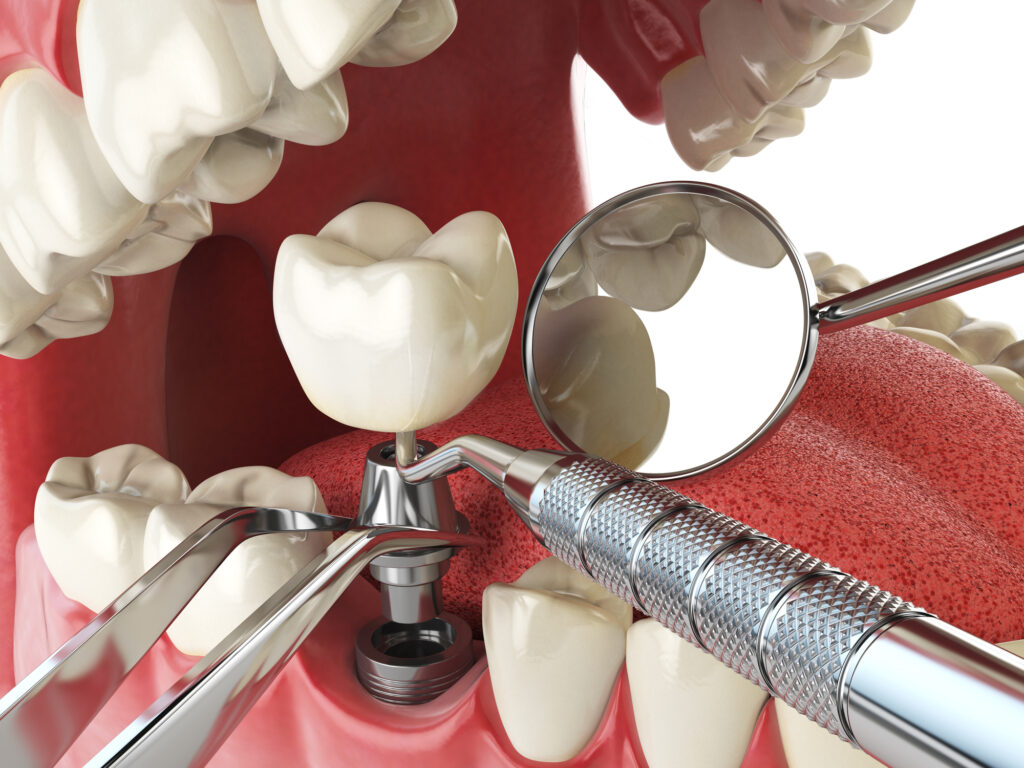 Silver Spring dentist inserting a dental crown for a patient